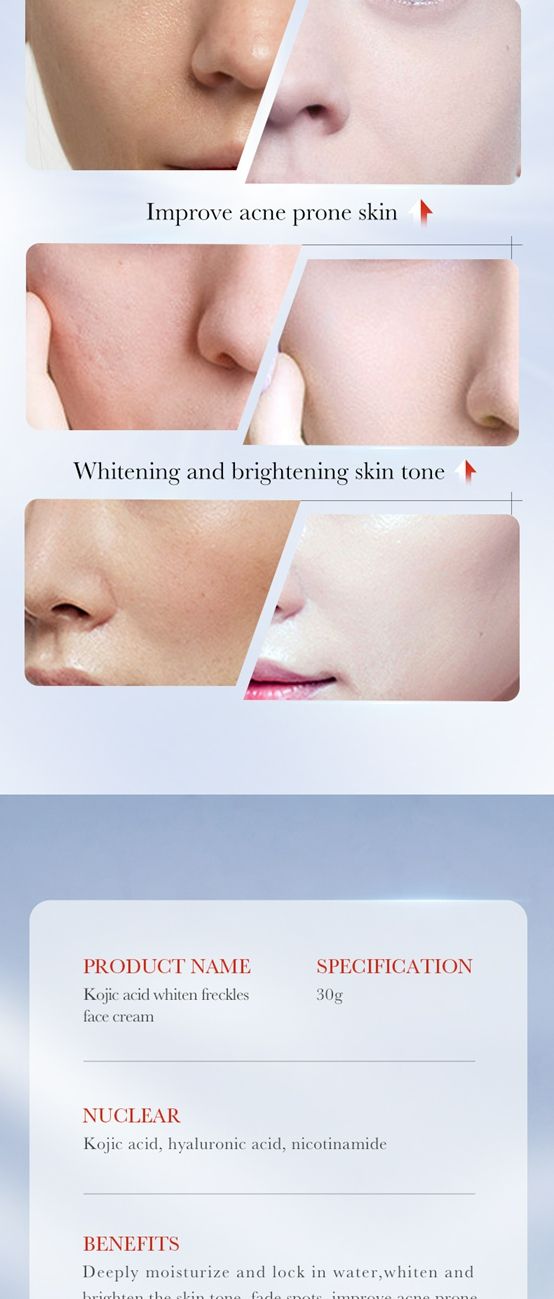 Kojic acid whitening and anti-freckle cream,Brightening and rejuvenating skin to remove melanin cream,whiten freckles face cream,kojic acid face cream