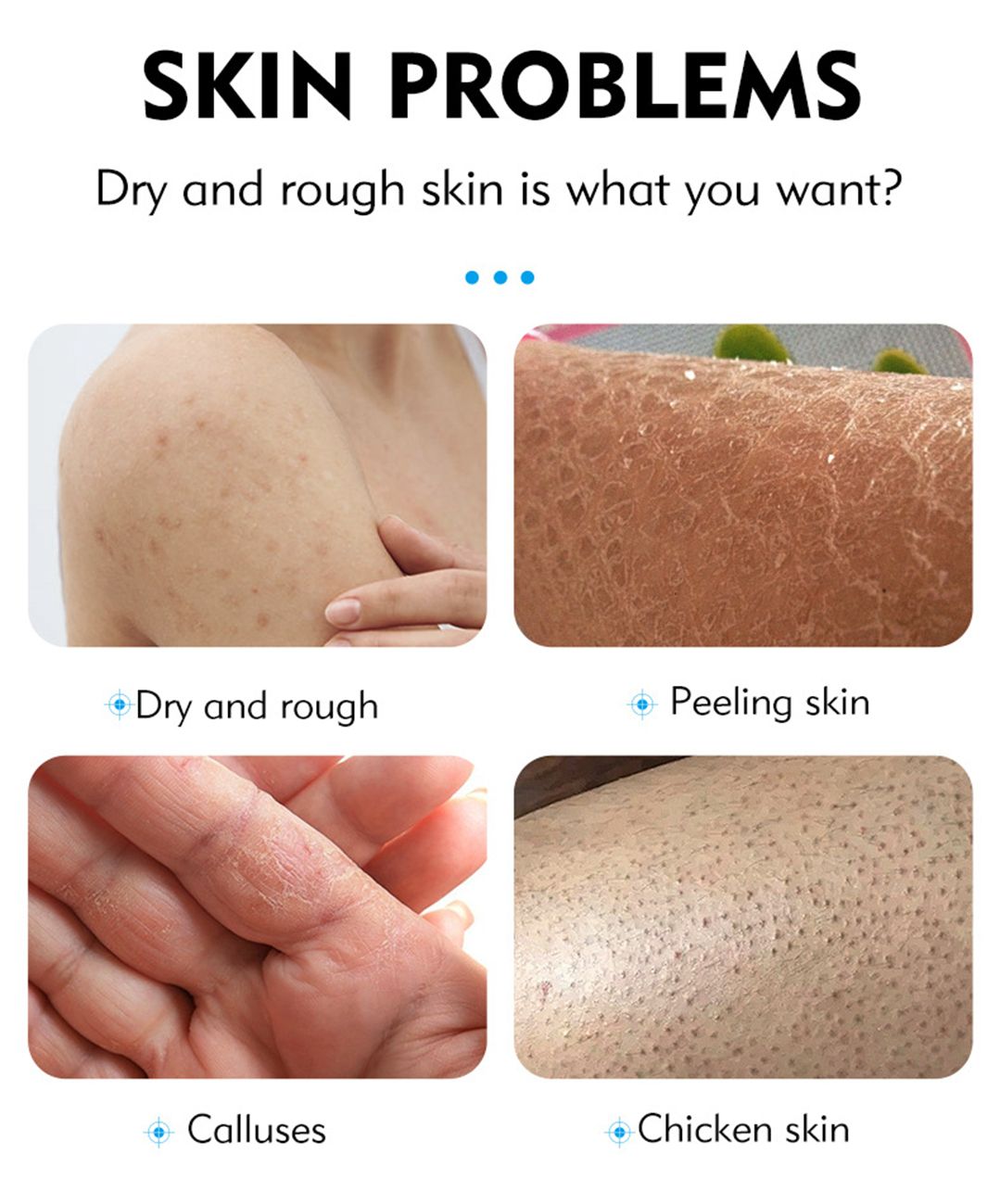 MOIKA 40% urea face cream anti-cracking moisturizing hand and foot cream