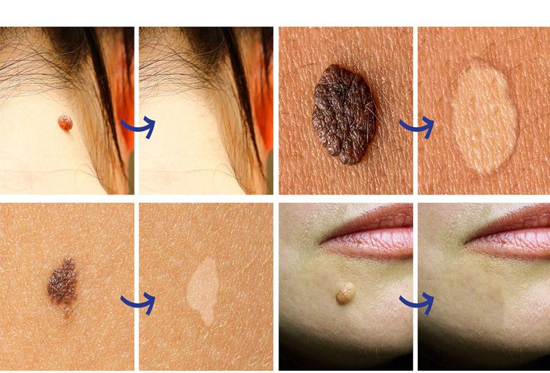 SAUVASINE wart removal liquid, warts, flat warts, especially condyloma acuminatum, wart removal liquid, moisturizing facial wart removal liquid