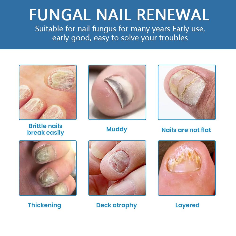 Sumifun K50010 Nail Fungus Care Spray | Toenail & Fingernail Repair Liquid | External Anti-Fungal Health Care Spray for Discolored, Brittle Nails

