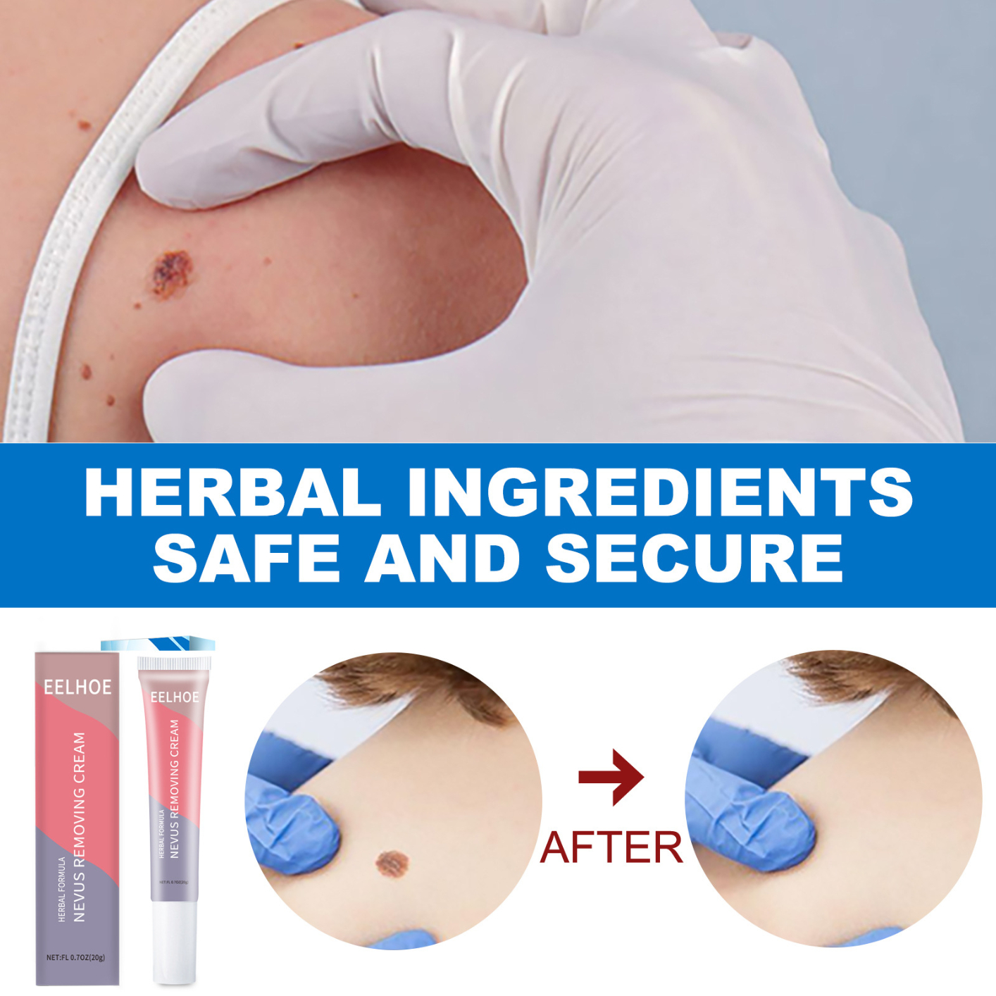 Wart Remover Blemish Removal Gel Skin Tag Remover Mole Remover Wart Remover Cream for Body Skin Tag Remover, Common Wart, with Natural Ingredients - Fast & Effective