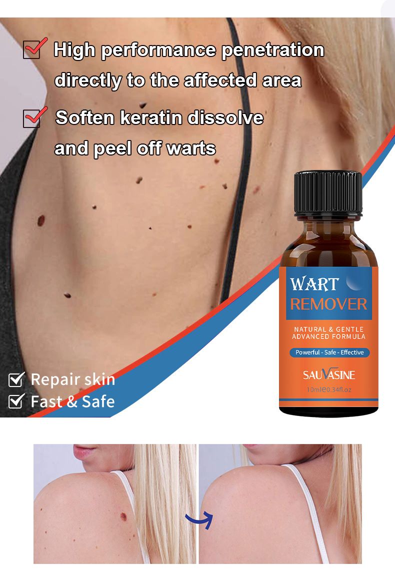 SAUVASINE wart removal liquid, warts, flat warts, especially condyloma acuminatum, wart removal liquid, moisturizing facial wart removal liquid