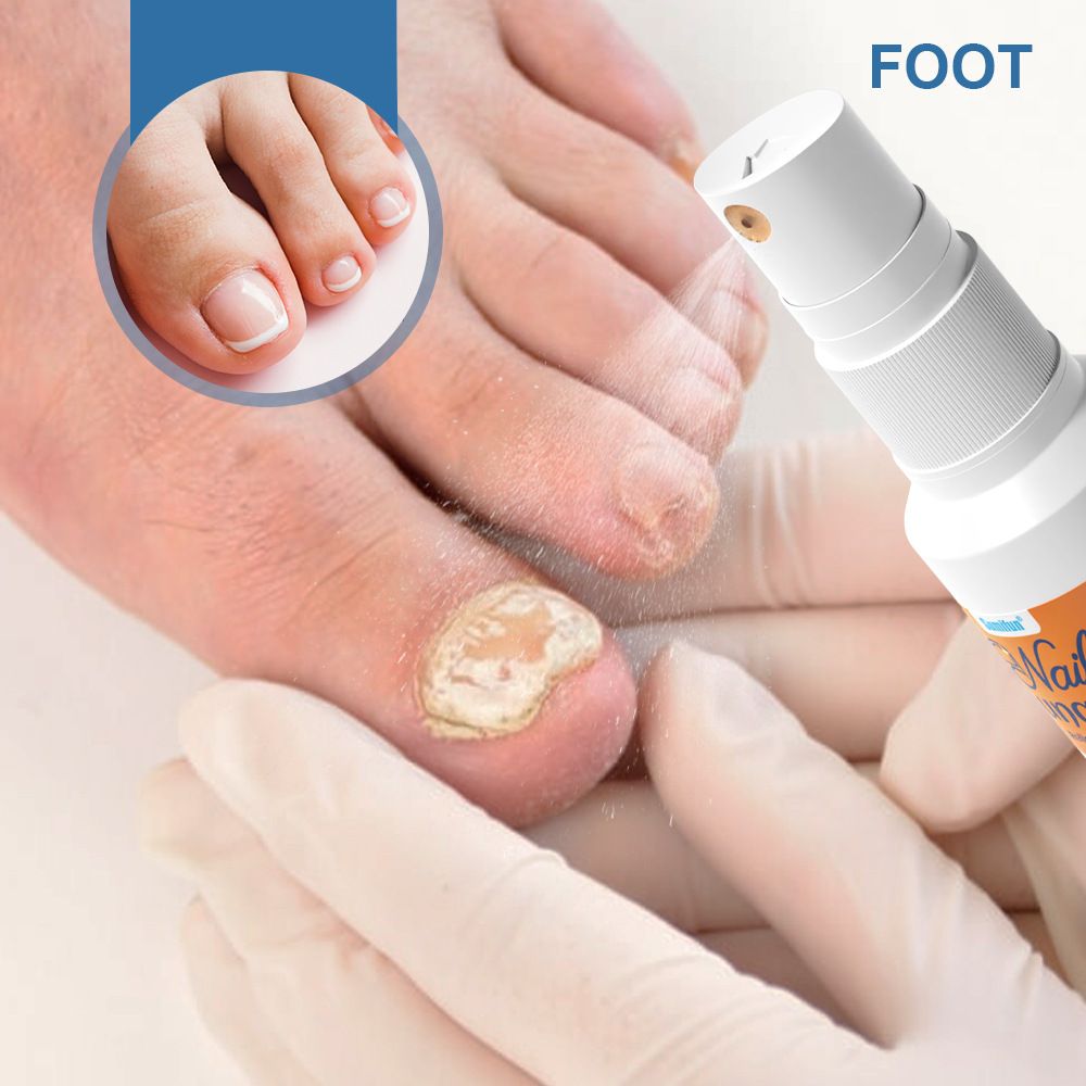 Sumifun K50010 Nail Fungus Care Spray | Toenail & Fingernail Repair Liquid | External Anti-Fungal Health Care Spray for Discolored, Brittle Nails
