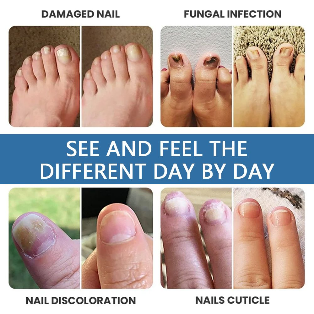Sumifun K50010 Nail Fungus Care Spray | Toenail & Fingernail Repair Liquid | External Anti-Fungal Health Care Spray for Discolored, Brittle Nails
