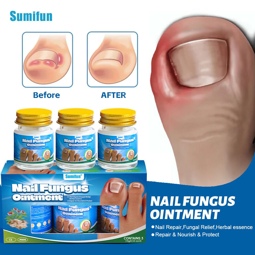 Sumifun Nail Fungus Treatment Ointment, Natural Herbal Nail Repair Cream, Nourishes & Protects Nails, Suitable for Thickened, Discolored & Infected Nails
