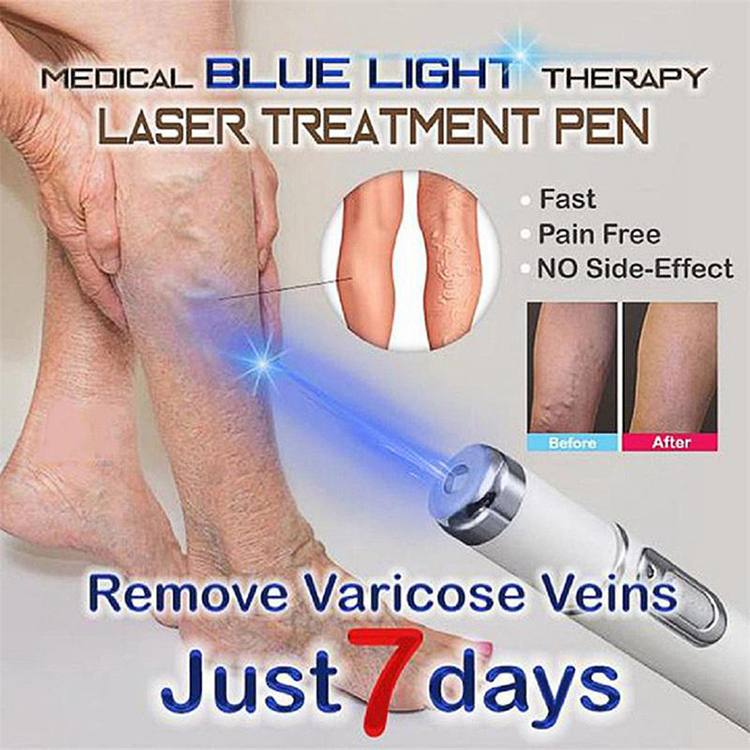 Amazing Blue Light Therapy Varicose Veins Treatment Laser Pen Soft Scar Wrinkle Removal Treatment Acne Laser Pen Massage Relax