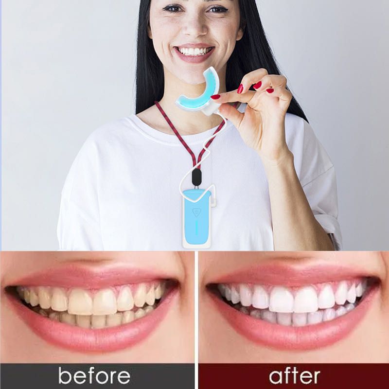 TEETH WHITENING DENTAL KIT-REVOLUTIONARY TEETH WHITENING SYSTEM 