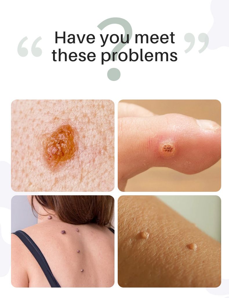 SAUVASINE wart removal liquid, warts, flat warts, especially condyloma acuminatum, wart removal liquid, moisturizing facial wart removal liquid