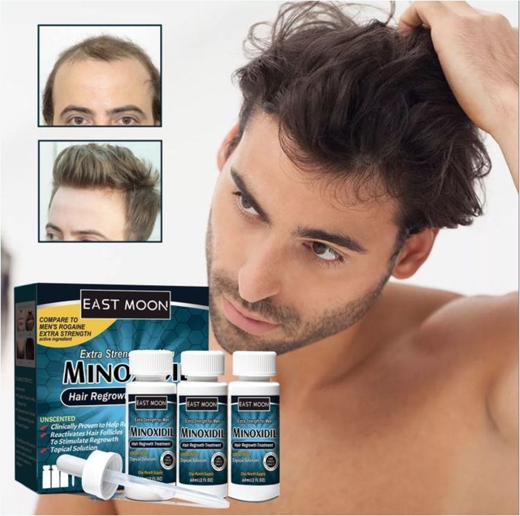 East Moon 3 Bottles Of Minoxidil Extra Strength Hair Regrowth For Men - 60ML